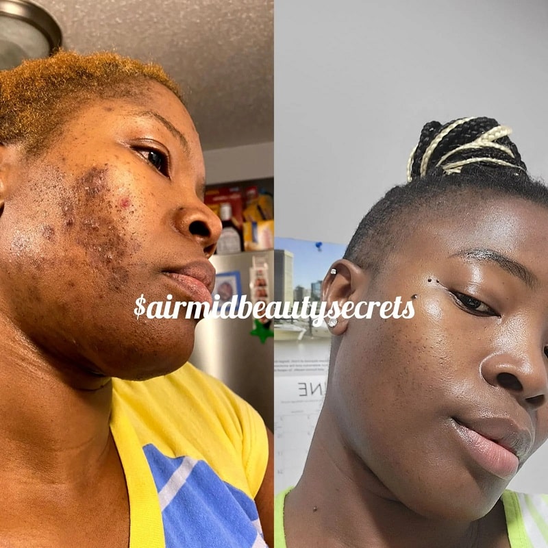 Kojic Acid Soap Before and After: Does It Really Lighten Skin? 11 Kojic Acid Soap Before and After: Does It Really Lighten Skin?