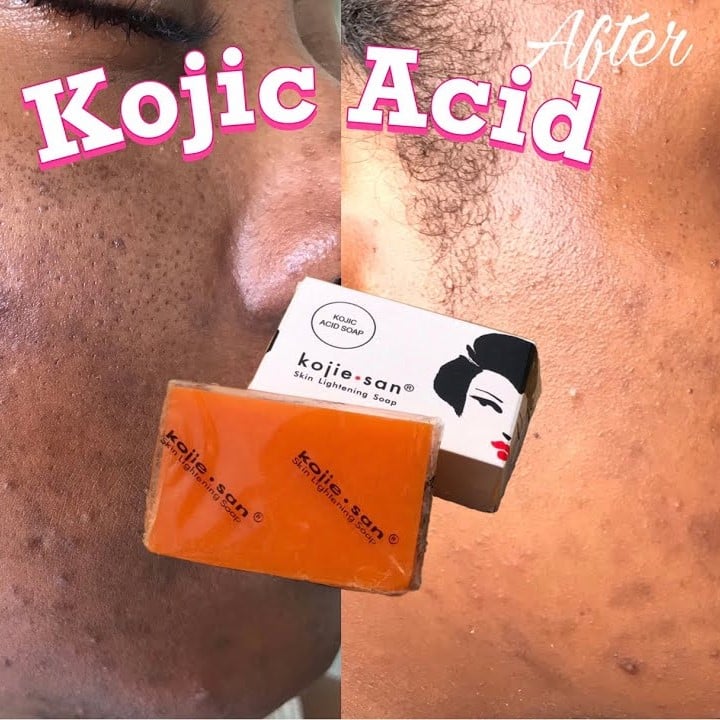 Kojic Acid Soap Before and After: Does It Really Lighten Skin? 16 Kojic Acid Soap Before and After: Does It Really Lighten Skin?
