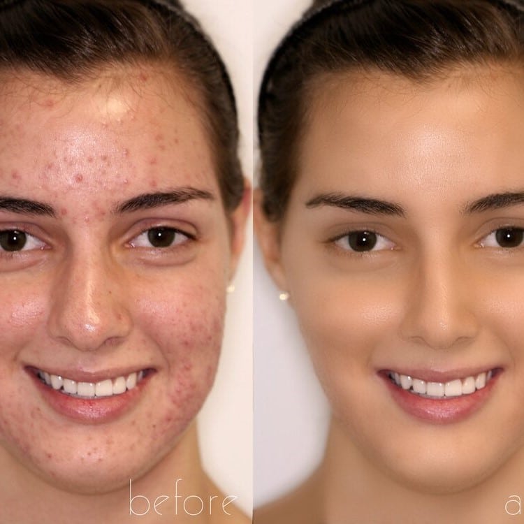 Kojic Acid Soap Before and After: Does It Really Lighten Skin? 18 Kojic Acid Soap Before and After: Does It Really Lighten Skin?