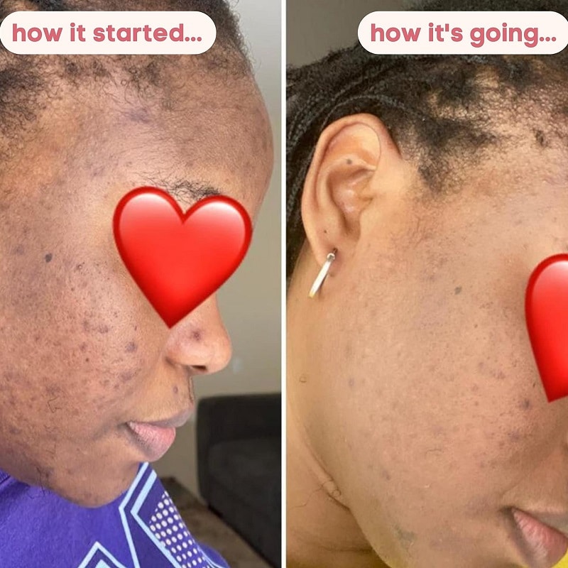 Kojic Acid Soap Before and After: Does It Really Lighten Skin? 7 Kojic Acid Soap Before and After: Does It Really Lighten Skin?